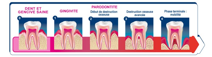 Les maladies parodontales